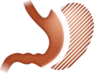 Gastric Sleeve in Turkey