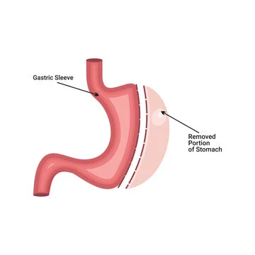 Understanding Gastric Sleeve Surgery: An In-Depth Overview
