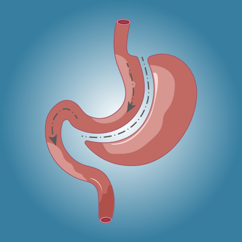 Gastric Sleeve in Türkiye