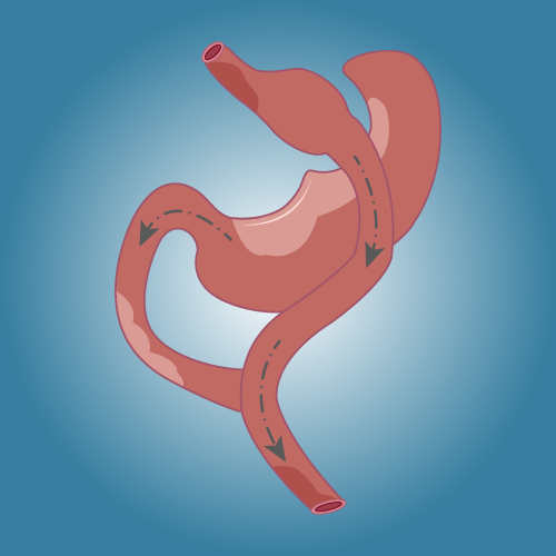 Gastric Bypass in Türkiye