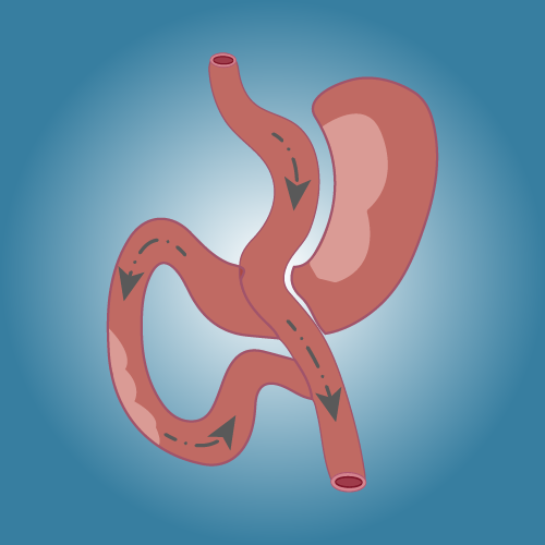 Mini-Gastric Bypass in Türkiye