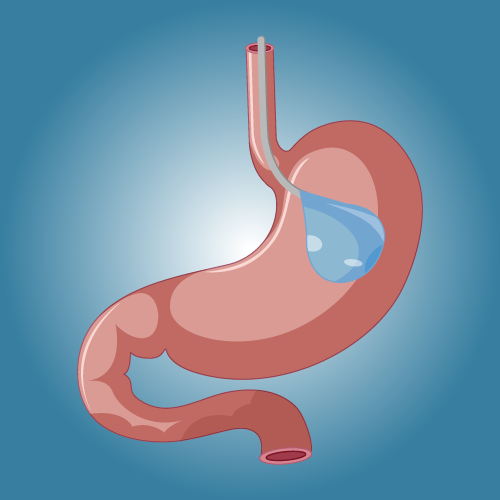 Gastric balloon in Türkiye