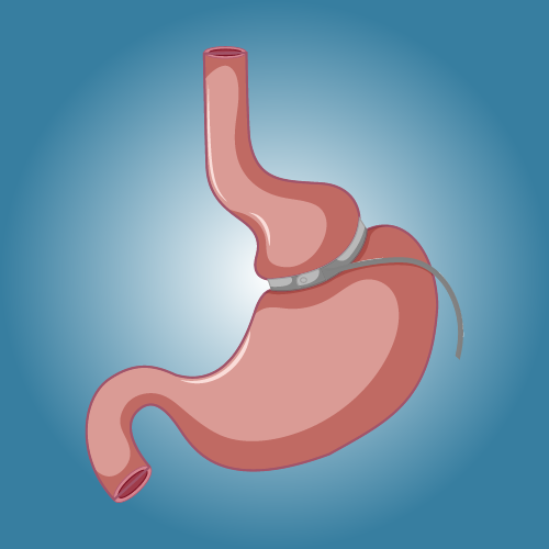 Gastric band in Türkiye